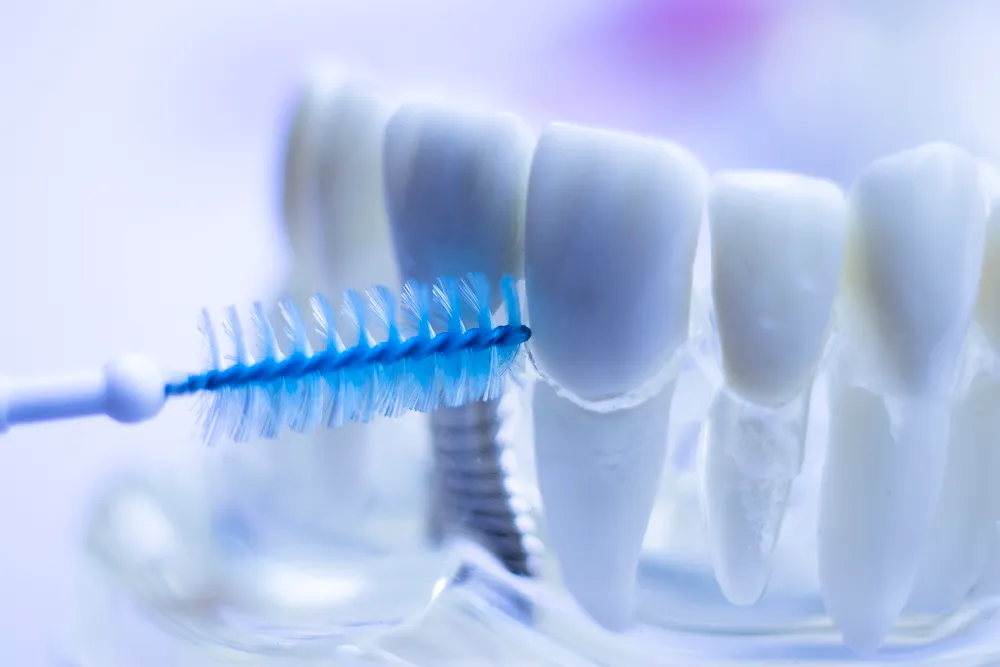 Manfaat Sikat Interdental untuk Gigi